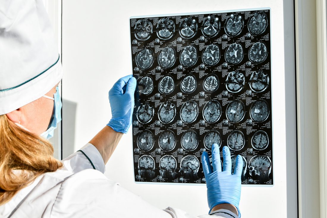 Refertazione di una risonanza magnetica encefalica: diagnostica per immagini e prevenzione a Napoli